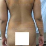does laser lipo really work Pune