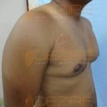 does laser lipo work before and after pictures Pune