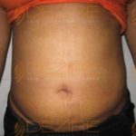 eliminate belly fat fast without surgery Pune