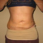 freeze fat away results Pune