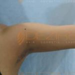 laser arm fat removal cost Pune