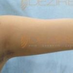 laser fat removal near me Pune