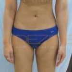 laser lipo before and after 1 treatment Pune