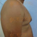 laser lipo before and after images Pune