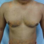 laser lipo results after 1 session Pune