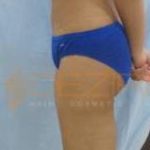 laser lipo sessions with whole-body vibration Pune
