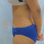 laser lipo treatments before and after Pune