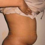 non surgical fat removal from stomach Pune