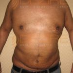 plastic surgery for morbidly obese Pune