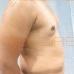 procedures to remove belly fat Pune
